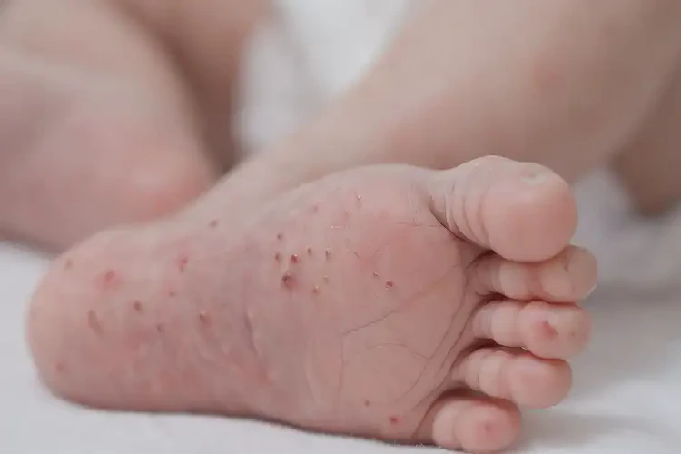 新生兒小腿偶爾長濕疹能徹底自愈嗎(圖3)