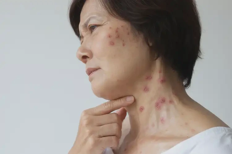 女人脖子偶爾長濕疹能徹底自愈嗎(圖4)