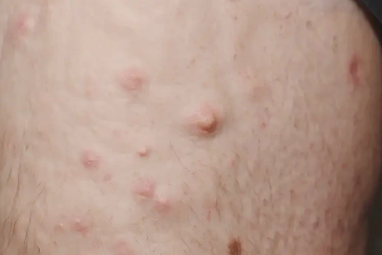 老年人大腿偶爾起濕疹不管它會自己好嗎(圖4)