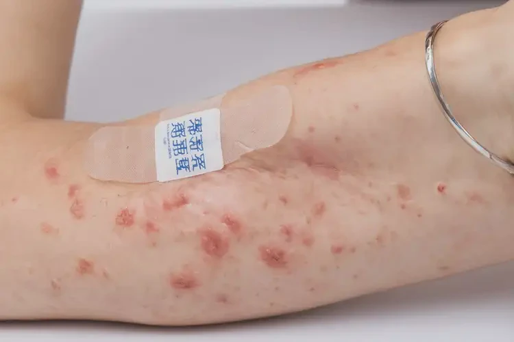 女人手臂偶爾長濕疹能夠徹底治愈嗎(圖4)