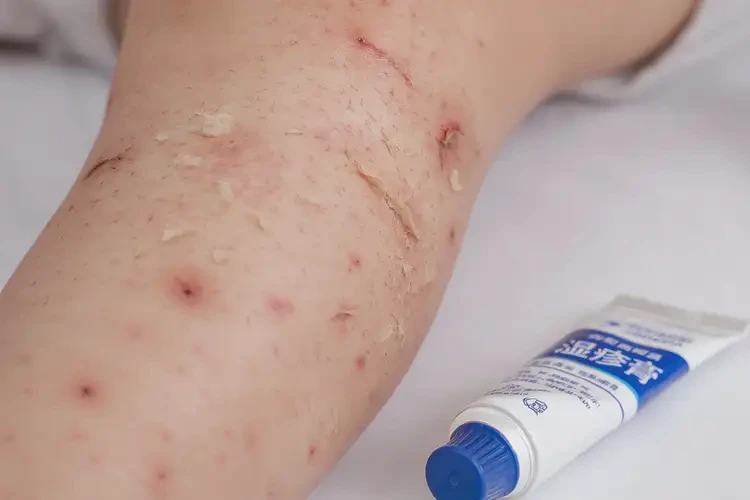 小孩小腿上有濕疹不管它會自己自愈嗎(圖4)