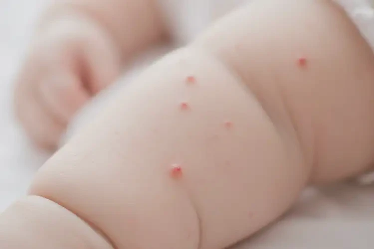 小兒手臂偶爾起濕疹能靠自己自愈嗎(圖4)