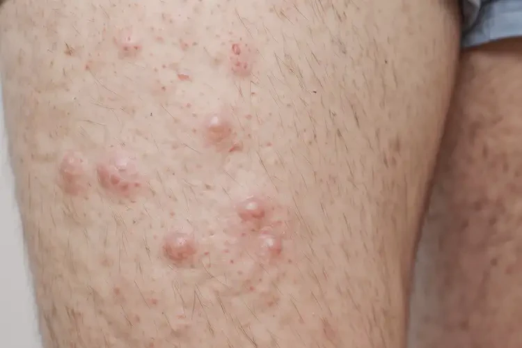 青年人大腿起濕疹可以徹底自愈嗎(圖4)