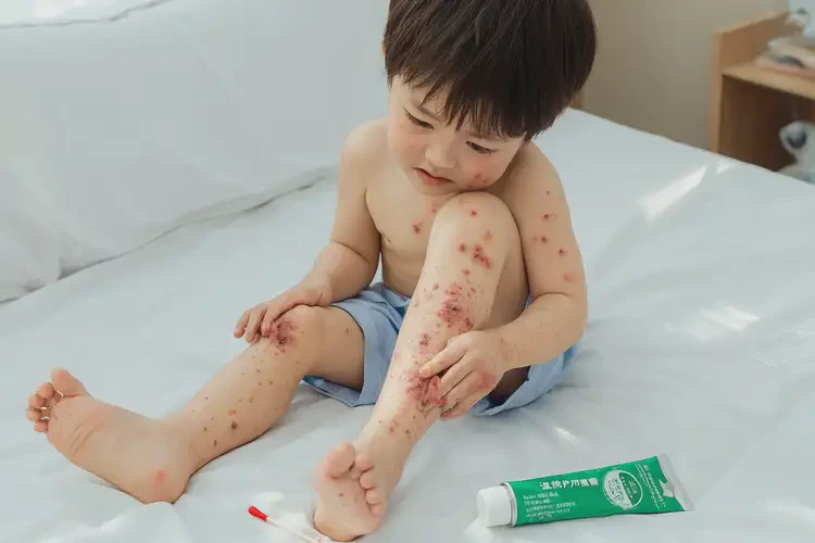 孩子大腿容易起濕疹不管它會(huì)自己好嗎(圖4)