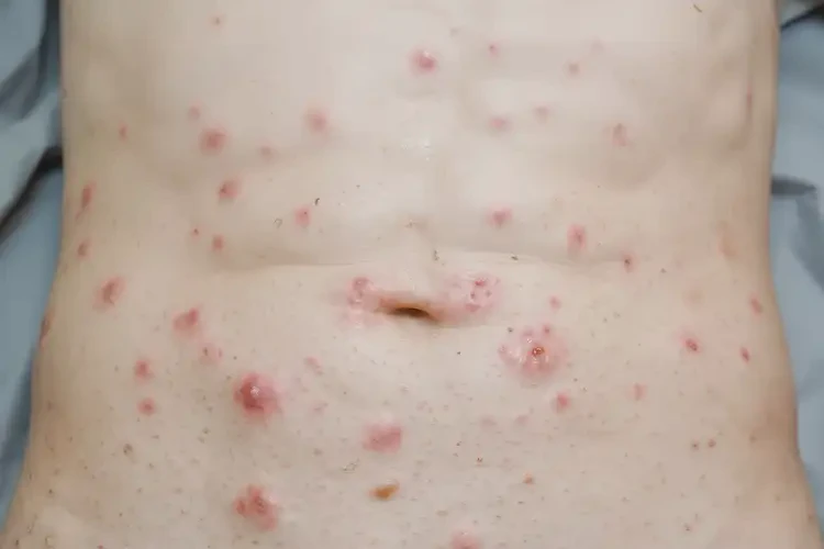 大學生肚子出濕疹可不可以徹底自愈(圖3)