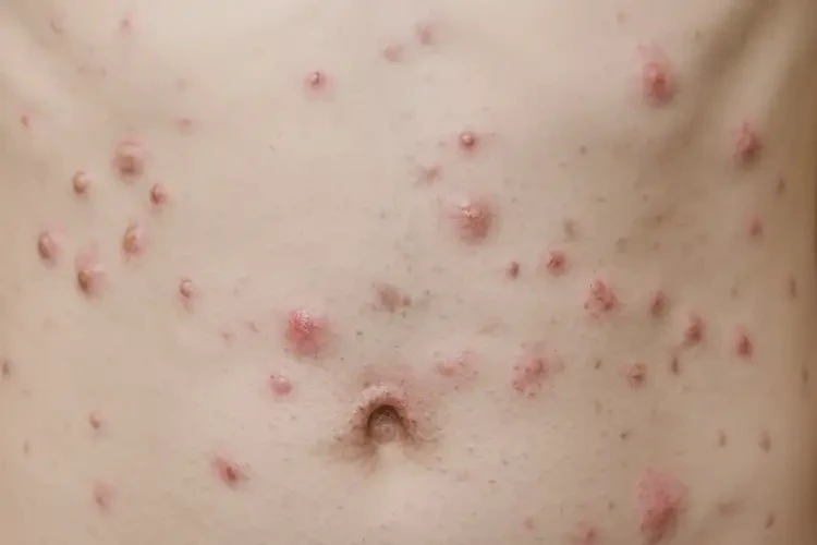 大學(xué)生肚子起濕疹能不能徹底自愈(圖4)