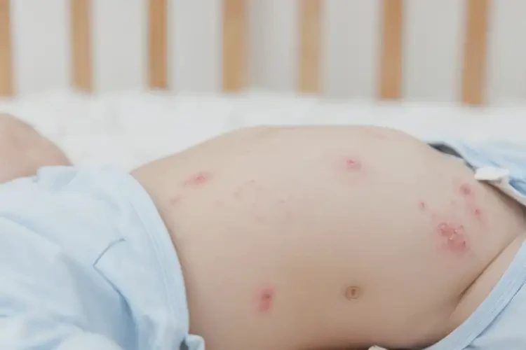 孩子肚子經(jīng)常長濕疹可不可以徹底自愈(圖4)