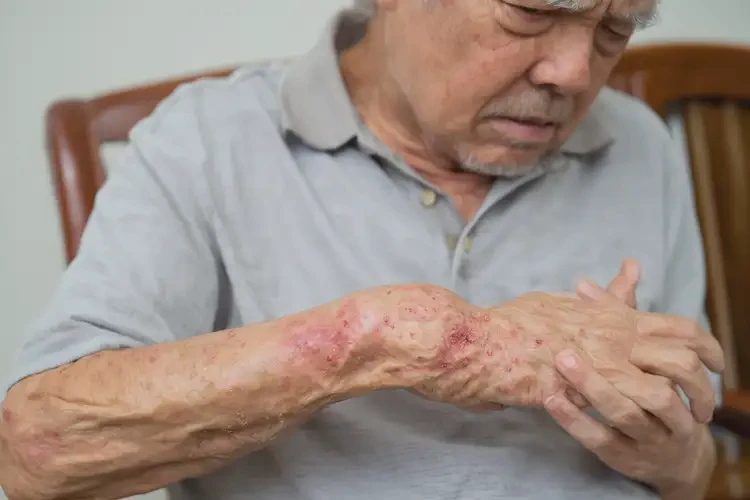 老人肛周出濕疹不管它會自己好嗎(圖4)