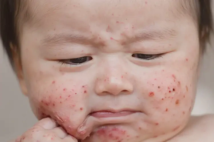 宝宝身上出现湿疹能彻底自愈吗(图4)