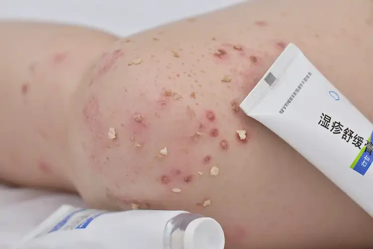 幼兒大腿上經(jīng)常起濕疹不管它會自己好嗎(圖4)