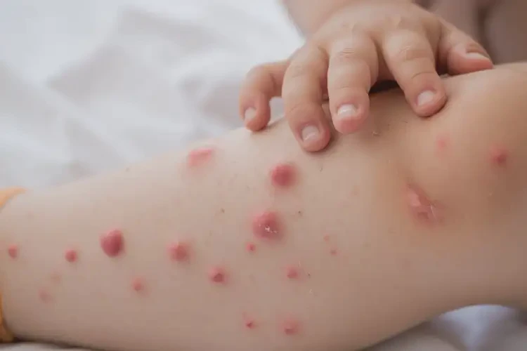 孩子小腿上出現(xiàn)濕疹不管它會自己自愈嗎(圖3)