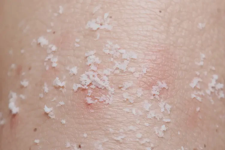 女人四肢有濕疹不管它會(huì)自己好嗎(圖3)