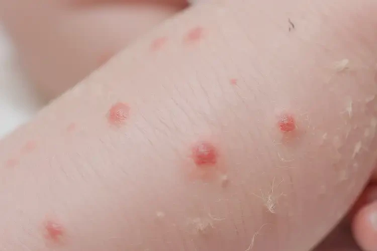 新生兒小腿偶爾長(zhǎng)濕疹不管它會(huì)自己自愈嗎(圖4)