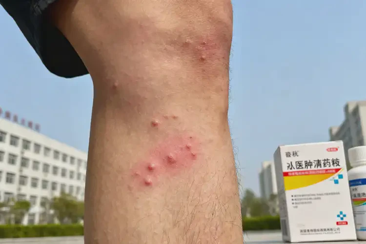 男生小腿上偶爾長濕疹不管它會(huì)自己好嗎(圖4)