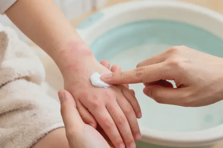 孩子手上偶爾長(zhǎng)濕疹能靠自己自愈嗎(圖1)