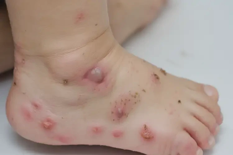 小兒腳上經(jīng)常長(zhǎng)濕疹能夠徹底治愈嗎(圖4)