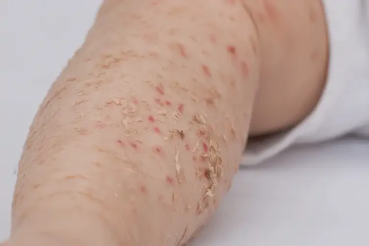 兒童四肢容易起濕疹不管它會自己自愈嗎(圖3)