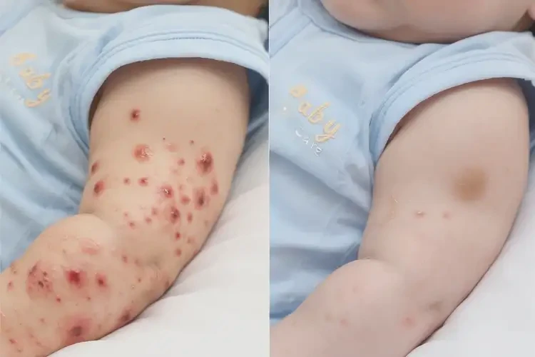 嬰兒手臂有濕疹能靠自己自愈嗎(圖1)