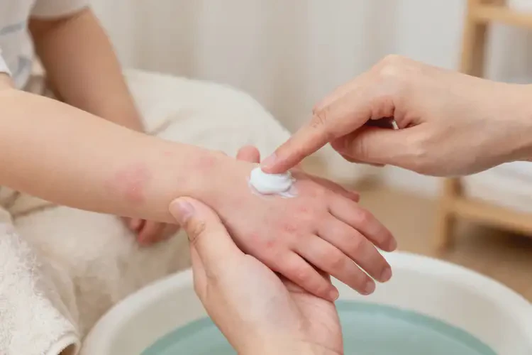 孩子手上偶爾長(zhǎng)濕疹能靠自己自愈嗎(圖2)