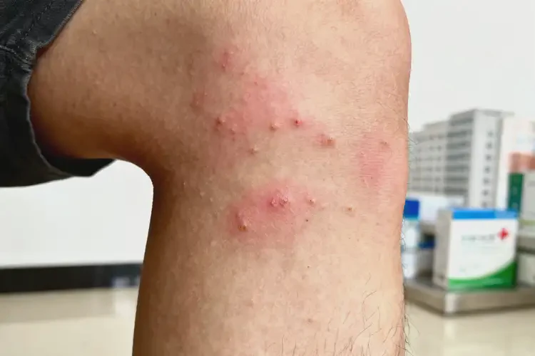 男生小腿上偶爾長濕疹不管它會(huì)自己好嗎(圖1)