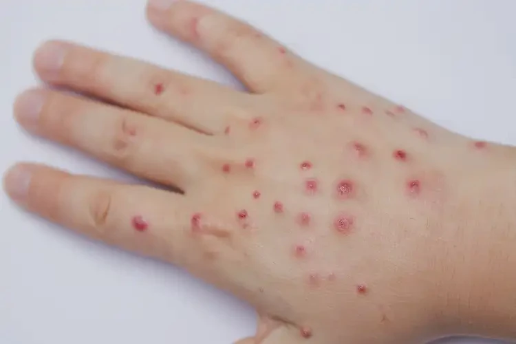 青少年手上偶爾起濕疹可不可以徹底自愈(圖4)