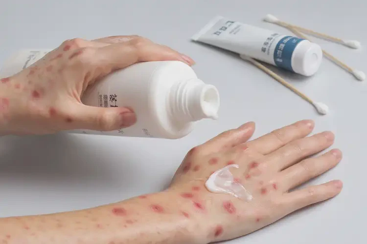 女性手上經(jīng)常長濕疹可不可以徹底自愈(圖3)
