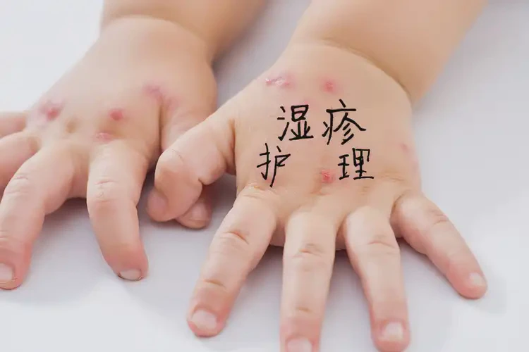 孩子手上經(jīng)常長濕疹能靠自己自愈嗎(圖4)