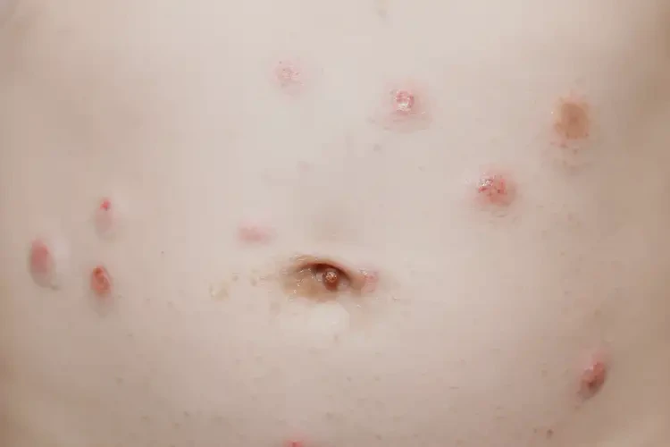 嬰幼兒肚子長(zhǎng)濕疹能夠徹底治愈嗎(圖4)