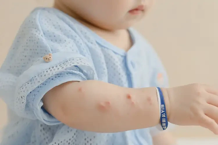 小兒手臂偶爾起濕疹能靠自己自愈嗎(圖3)