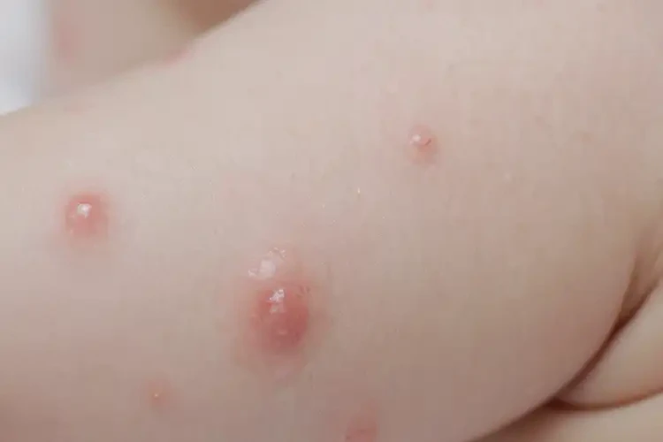 嬰兒四肢經(jīng)常長濕疹能徹底自愈嗎(圖4)