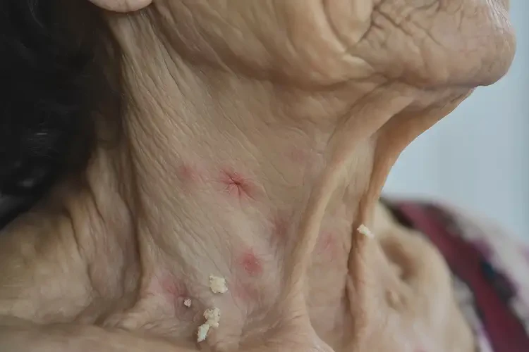 老年人脖子偶爾起濕疹能夠徹底治愈嗎(圖4)