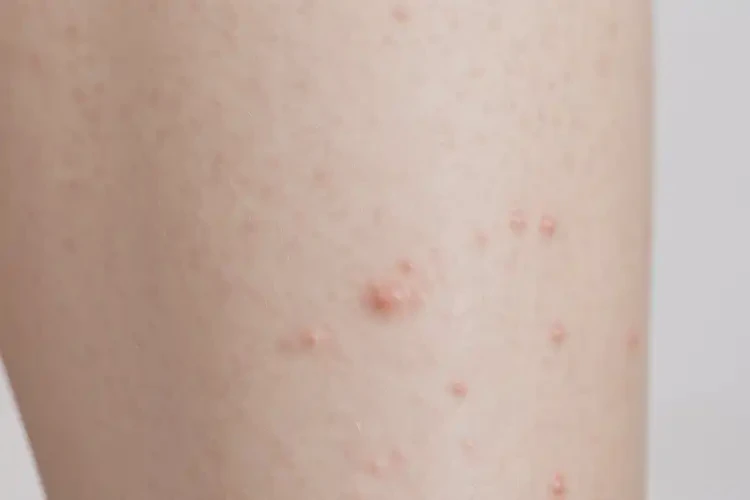 女生小腿偶爾長濕疹能靠自己自愈嗎(圖4)