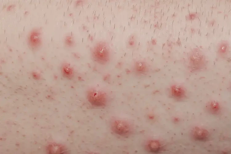 男人小腿上長濕疹可以徹底自愈嗎(圖3)