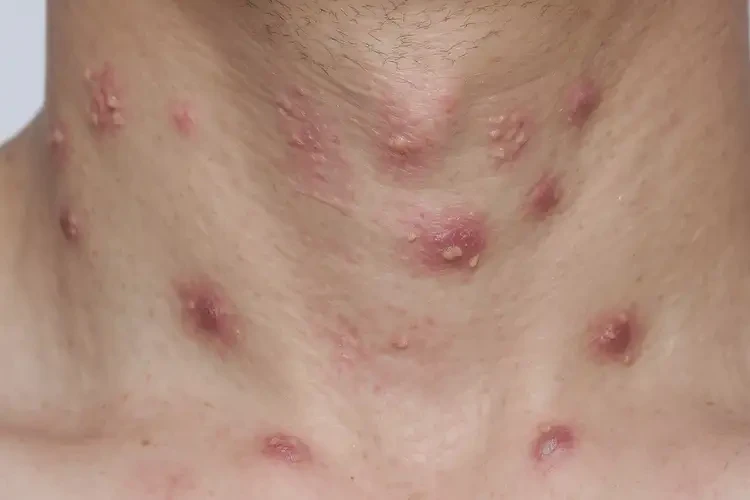 青年人脖子上容易起濕疹不管它會自己自愈嗎(圖4)