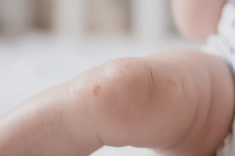 少兒小腿出現(xiàn)濕疹可不可以徹底自愈(圖4)