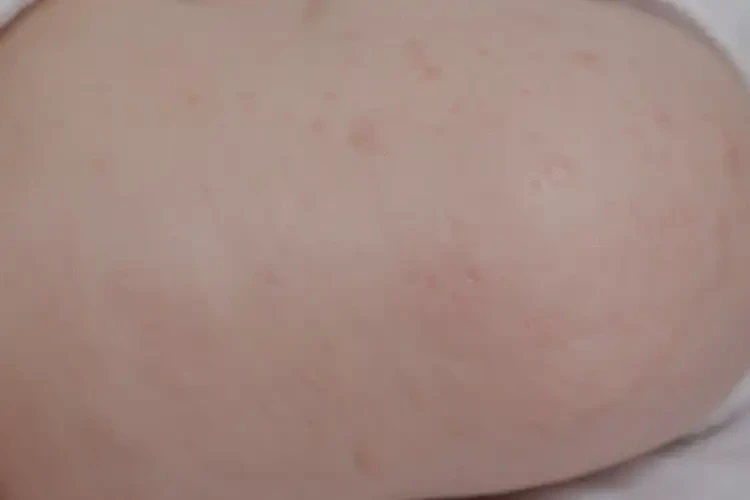 嬰幼兒肛周偶爾起濕疹能徹底自愈嗎(圖1)