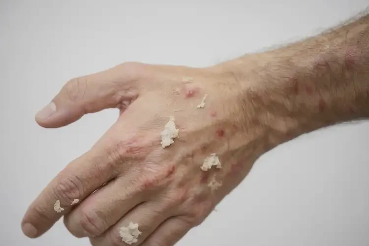 男性手上偶爾起濕疹可以徹底自愈嗎(圖4)