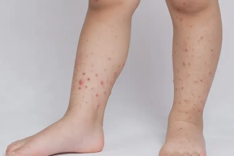 小學(xué)生四肢容易長濕疹能靠自己自愈嗎(圖4)