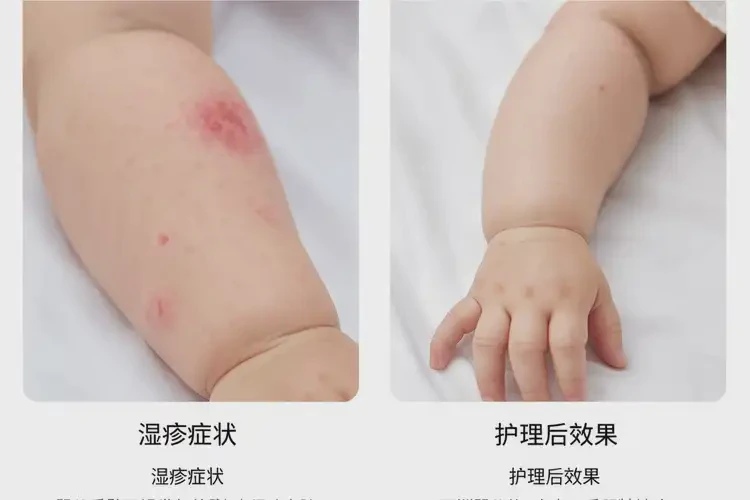 孩子肚子經(jīng)常長濕疹可不可以徹底自愈(圖2)