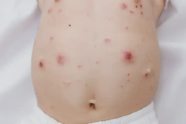 婴幼儿肚子经常起湿疹能彻底自愈吗(图4)