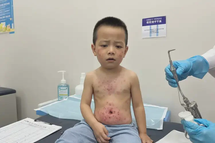 小孩肛周出濕疹不管它會自己痊愈嗎(圖4)