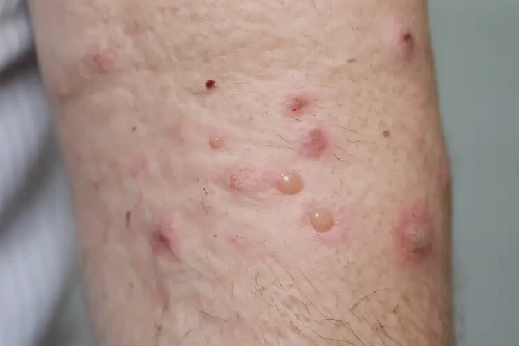 女生脖子上偶爾起濕疹不管它會(huì)自己自愈嗎(圖3)