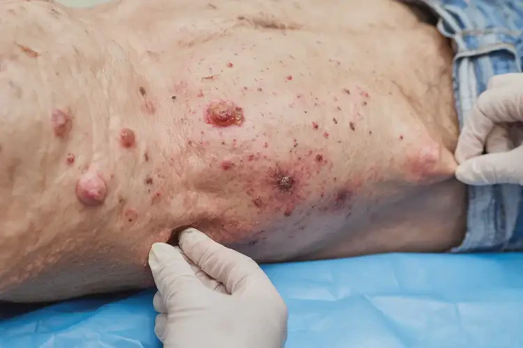 高齡老人肛周容易長(zhǎng)濕疹可不可以徹底自愈(圖4)