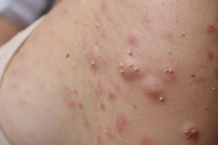 女性手臂上長濕疹可不可以徹底自愈(圖4)