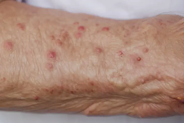 高齡老人手臂上容易長(zhǎng)濕疹不管它會(huì)自己好嗎(圖4)