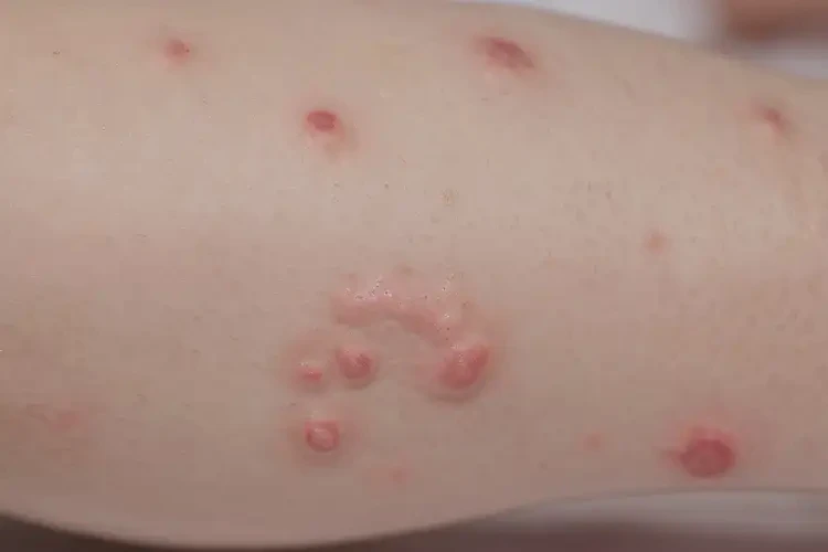 幼兒小腿上出現(xiàn)濕疹可以徹底自愈嗎(圖4)