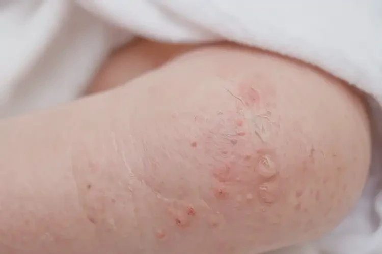 新生兒大腿容易起濕疹能徹底自愈嗎(圖4)