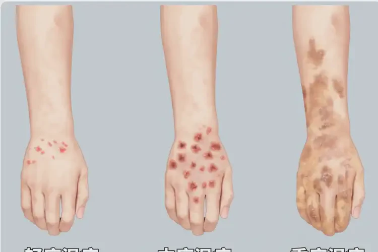 女生脖子偶爾長(zhǎng)濕疹不管它會(huì)自己好嗎(圖1)