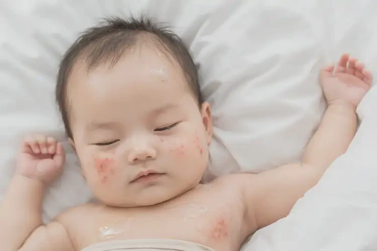 寶寶脖子起濕疹不管它會(huì)自己好嗎(圖4)