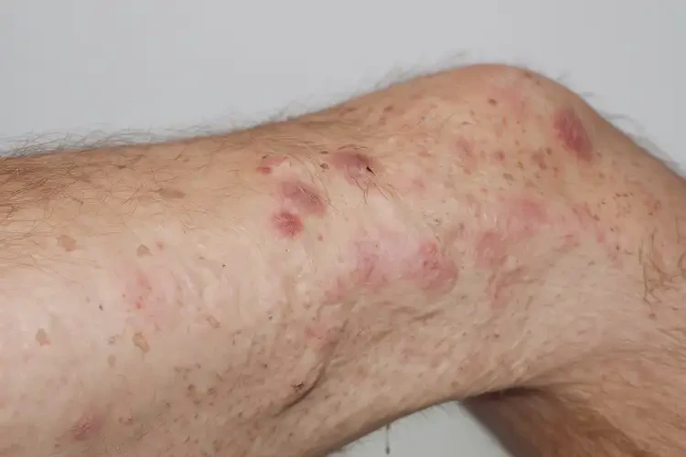 男性四肢經(jīng)常長濕疹可不可以徹底自愈(圖4)